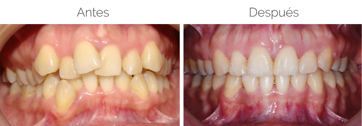 Multodent-ortodoncia-caso-1