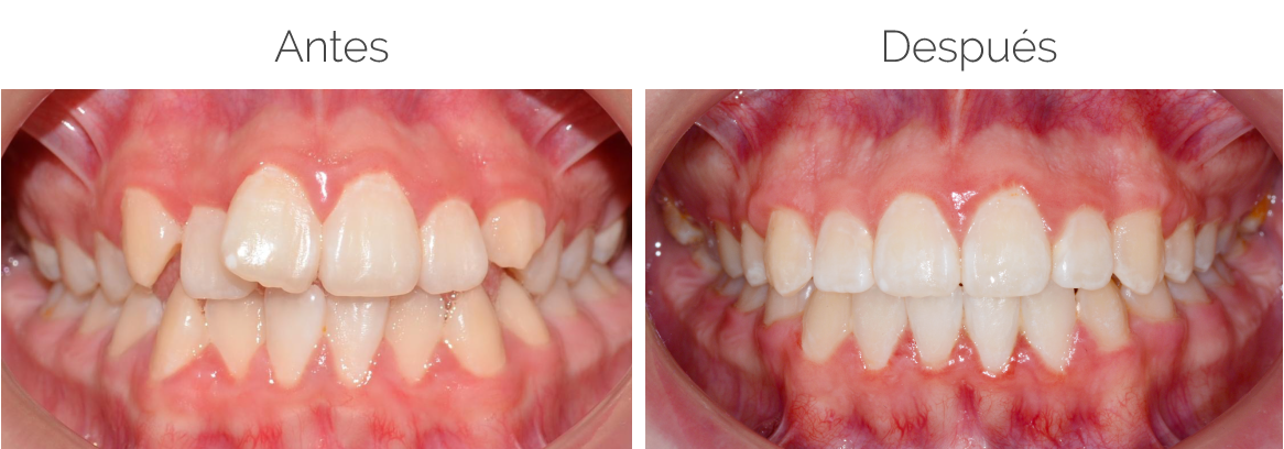 Multodent-ortodoncia-caso-2